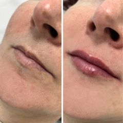 Clínica Carlos Gómez - Aumento de labios