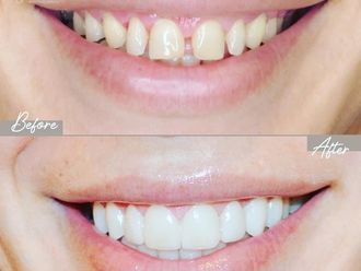 Carillas dentales - 853688