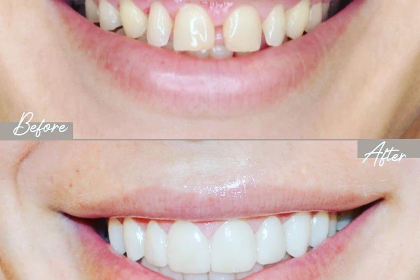 Carillas dentales antes y después - 853688
