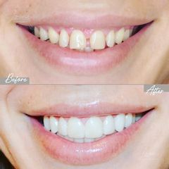 Carillas dentales- Clínica Alpha Dental