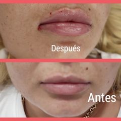 Aumento de labios - Clínica Alphadent