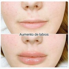 Aumento de labios - Clínica Alphadent