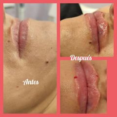 Aumento de labios - Clínica Alphadent