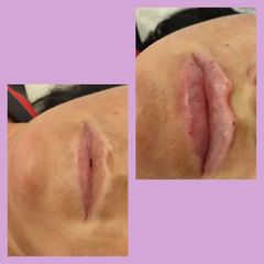 Aumento de labios - Clínica Alphadent