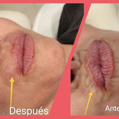 Rellenos faciales - Clínica Alphadent