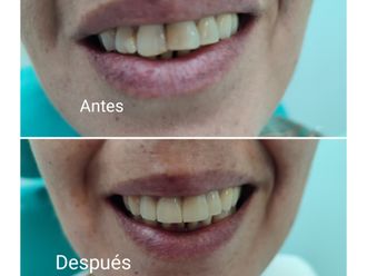 Carillas dentales - 853730