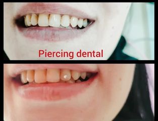 Piercing dental - Clínica Alphadent