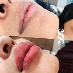 Aumento de labios - Sikuw Experience