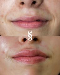 Aumento de labios - Sikuw Experience