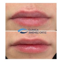 Aumento de labios - Dr. Jiménez Ortiz