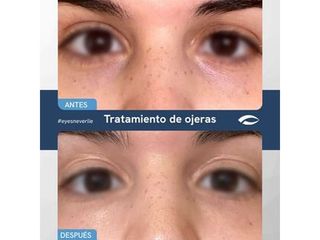 Eliminación de ojeras - Dr. Jiménez Ortiz