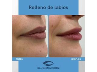 Relleno de labios - Dr. Jiménez Ortiz
