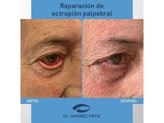 Reparación de ectropión palpebral - Dr. Jiménez Ortiz