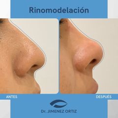 Rinomodelación - Dr. Jiménez Ortiz