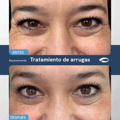Eliminación antiarrugas - Dr. Jiménez Ortiz