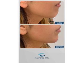 Definicion mandibular - Dr. Jiménez Ortiz