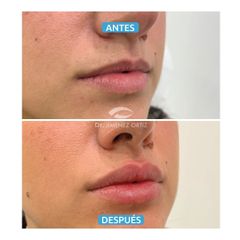 Aumento de labios - Dr. Jiménez Ortiz