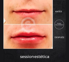 Antes y después Aumento de Labios