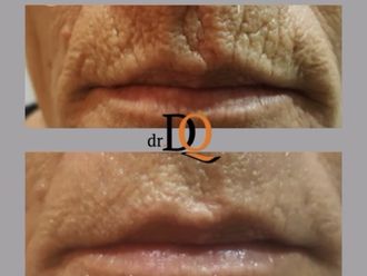 Aumento labios antes y después - 877729