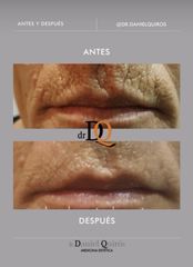 Aumento Labios - Session Estética