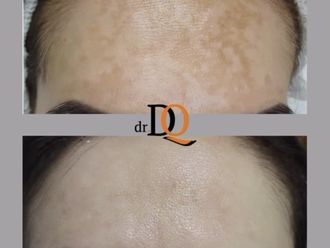 Tratamiento antimanchas antes y después - 877731