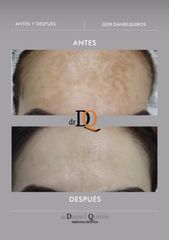 Tratamientos antimanchas - Session Estética