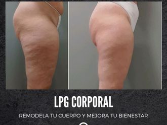 Eliminar grasa localizada antes y después - 877732