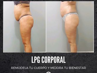 Eliminar grasa localizada antes y después - 877733