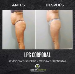 Eliminación de Grasa Localizada - Session Estética