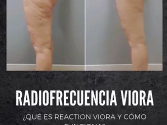 Eliminar grasa localizada antes y después - 877734