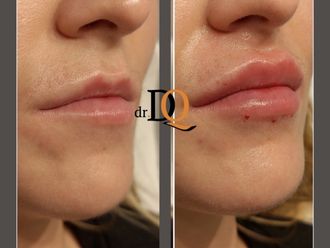 Aumento labios antes y después - 877735