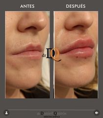 Aumento Labios - Session Estética