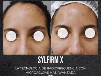 Microneedling antes y después - 877736