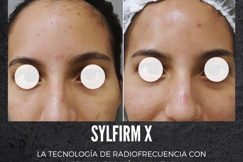 Microneedling antes y después - 877736