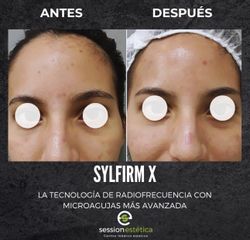 Microneeding - Session Estética