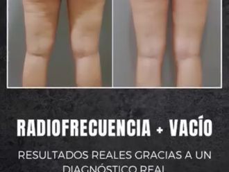 Eliminar grasa localizada antes y después - 877737