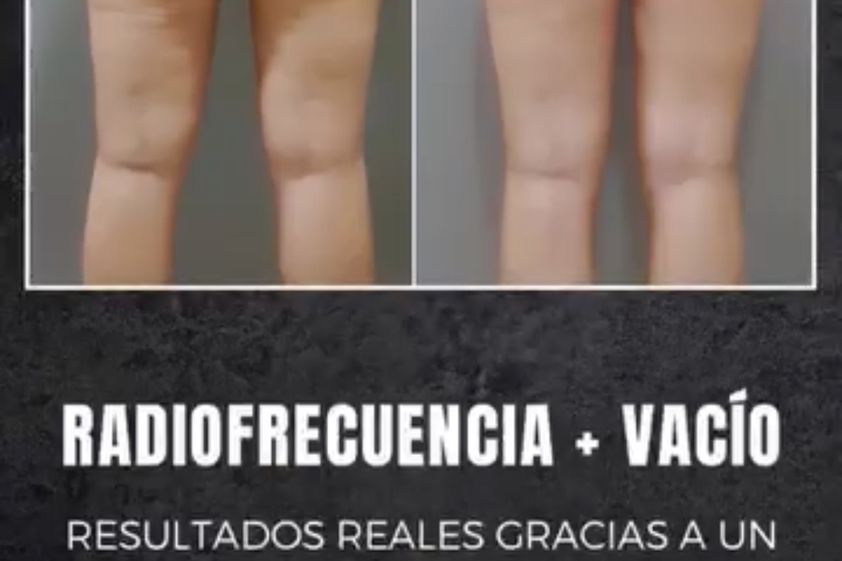 Eliminar grasa localizada antes y después - 877737