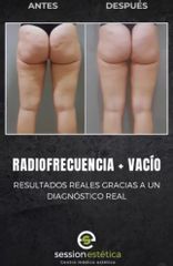 Eliminar grasa localizada - Session Estética