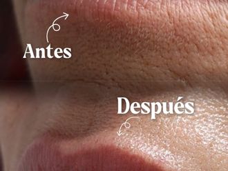 Aumento labios antes y después - 877738