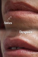 Aumento Labios - Session Estética