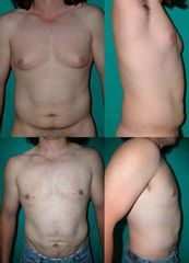 Ginecomastia y Liposucción - Dr. José Luis Diaz Infante