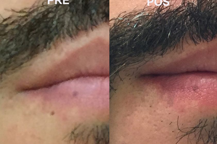 Corrección cicatrices antes y después - 528873