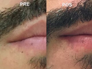 Corección de cicatrices piercing - Dr. José Luis Díaz Infante