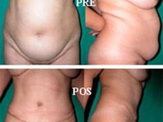 Abdominoplastia antes y después - 872952