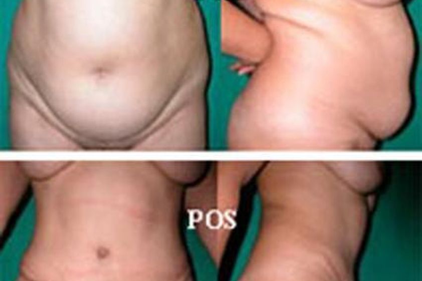 Abdominoplastia antes y después - 872952