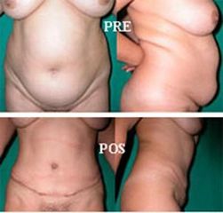 Abdominoplastia