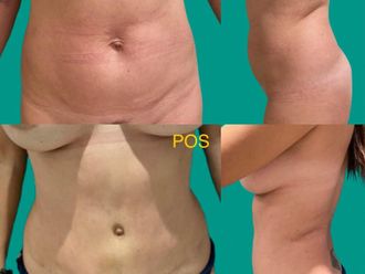 Abdominoplastia antes y después - 872953