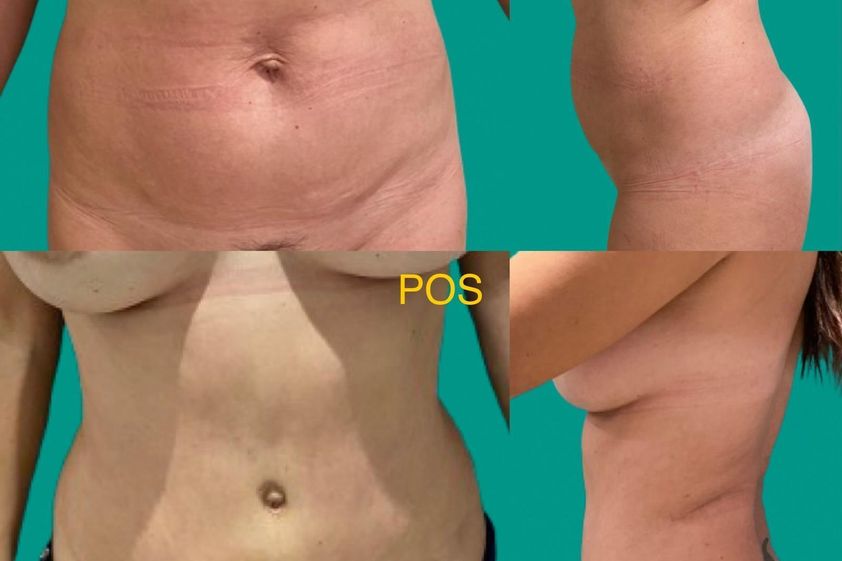 Abdominoplastia antes y después - 872953