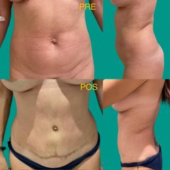 Abdominoplastia