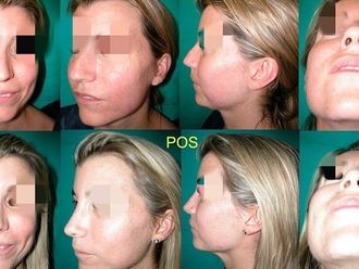 Rinoplastia antes y después - 875270